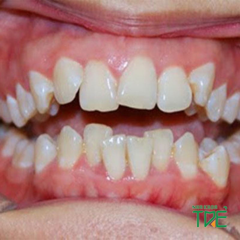 Điều trị răng bị nghiêng bằng phương pháp nào hiệu quả nhất?