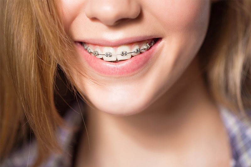 Niềng răng thẩm mỹ khắc phục tình trạng răng nghiêng hiệu quả