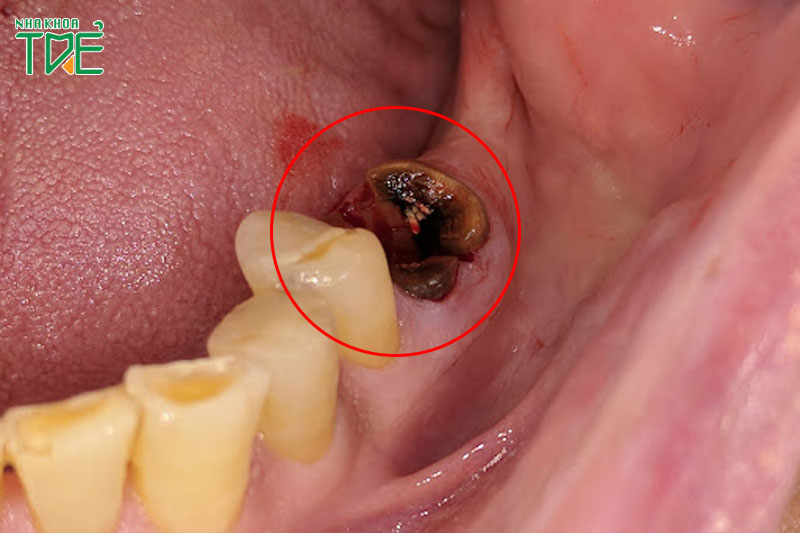 Nhổ răng vĩnh viễn nếu răng sâu hỏng quá nặng