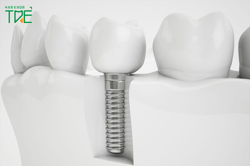 Cấy ghép Implant không xâm lấn các răng khỏe mạnh