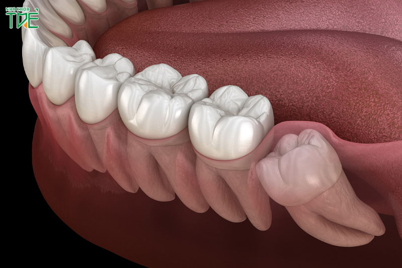 Răng khôn mọc lệch, mọc ngầm gây ra nhiều biến chứng nguy hiểm