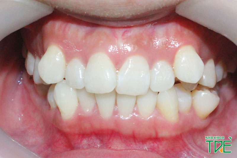 Răng khấp khểnh, chen chúc nặng cần phải nhổ răng