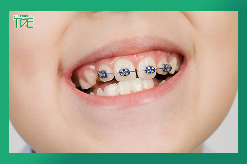 Niềng 1 răng lệch đạt hiệu quả cao ở giai đoạn đang phát triển xương hàm
