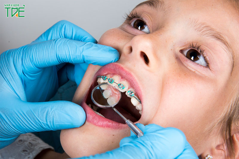 Niềng răng để điều chỉnh răng và khớp cắn đạt tỷ lệ chuẩn