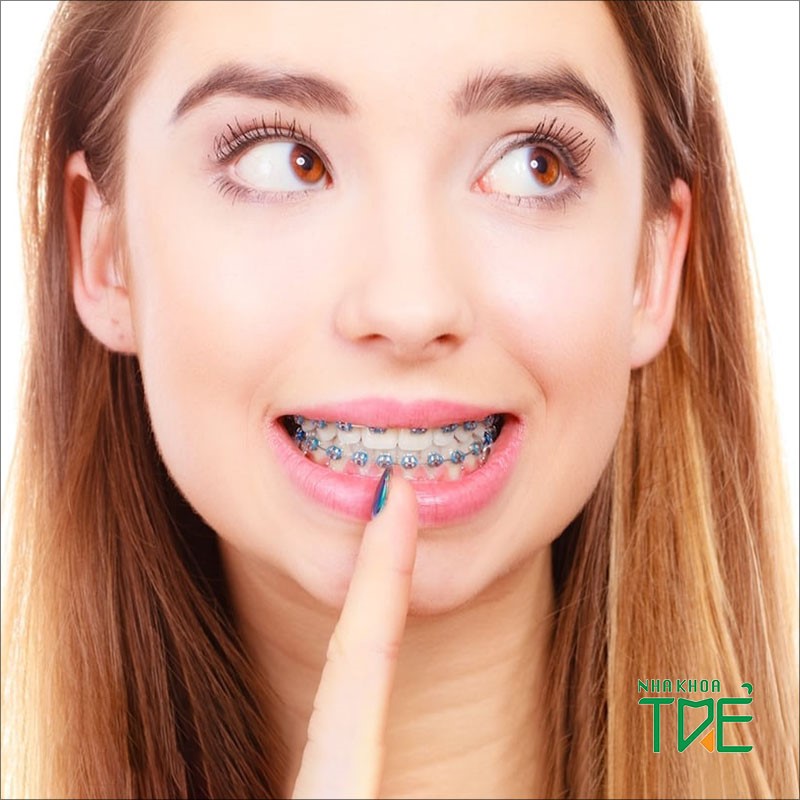 Niềng răng không nhổ răng được áp dụng với những trường hợp nào?