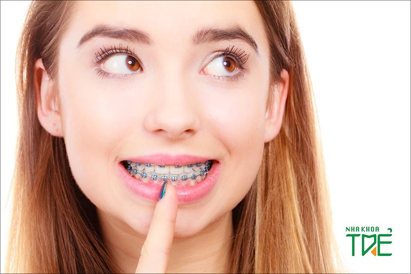 Niềng răng không nhổ răng được áp dụng với những trường hợp nào?