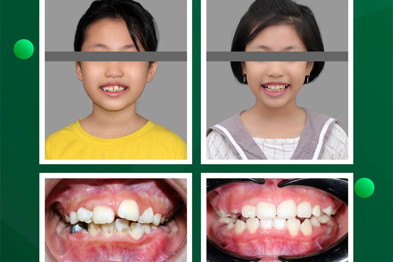 Trẻ em nên chỉnh nha không nhổ răng