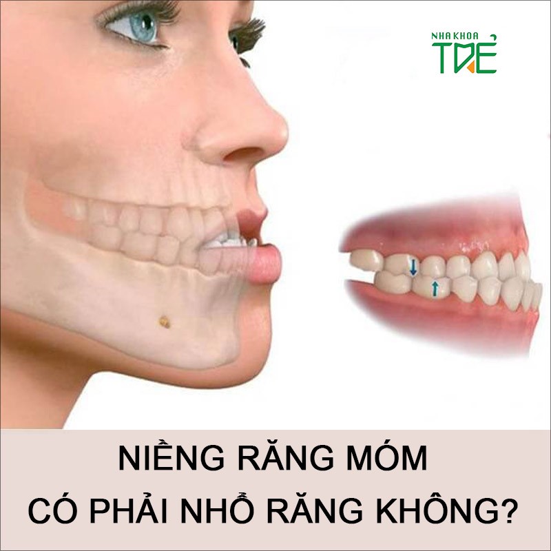 Niềng răng móm có phải nhổ răng không?