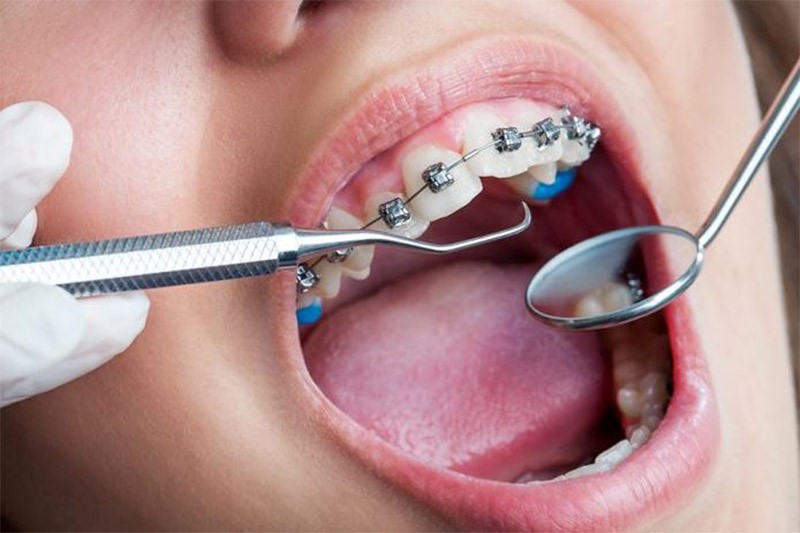 Niềng răng móm có phải nhổ răng không còn tùy thuộc vào mức độ nặng nhẹ và độ tuổi