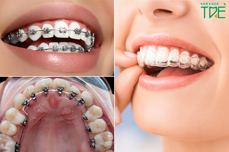 Các phương pháp niềng răng được ứng dụng ở Nhật