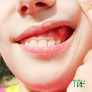 Nướu răng nổi cục thịt có nguy hiểm không? – Cách điều trị dứt điểm
