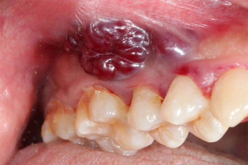 Ung thư nướu răng đe dọa tính mạng con người