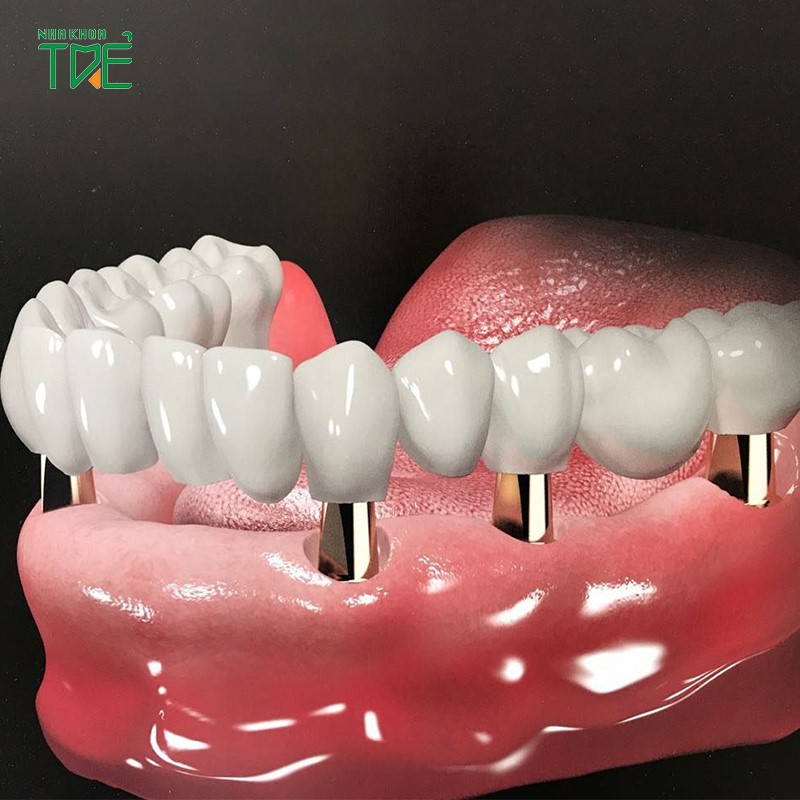Phục hình răng sứ trên Implant là gì? Các loại răng sứ phục hình phổ biến nhất