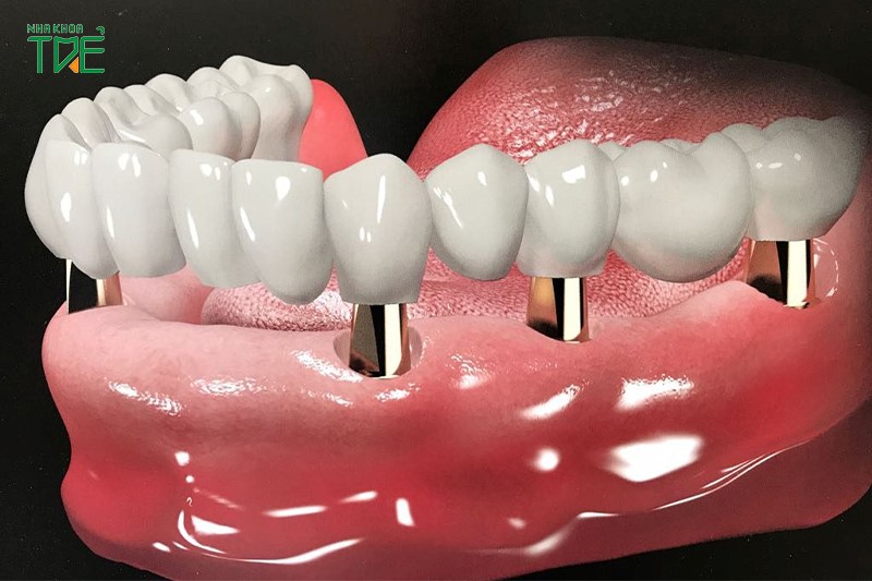 Phục hình răng sứ trên Implant như thế nào?