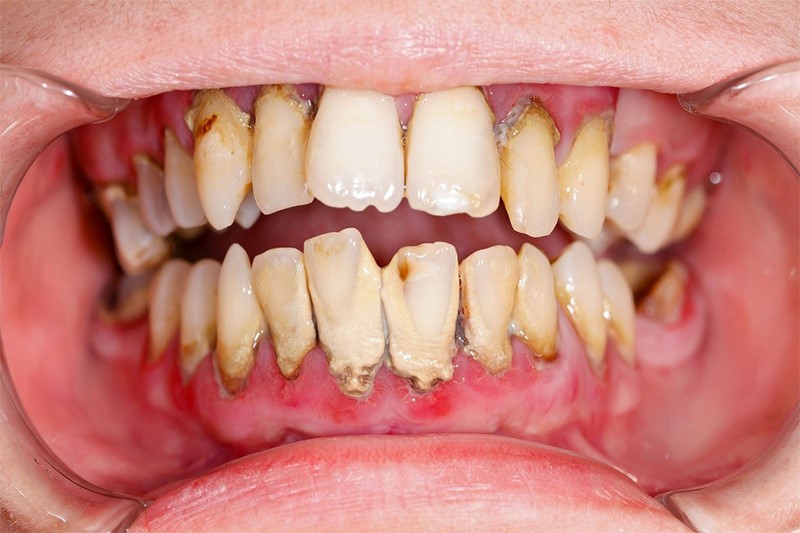 Cần điều trị các bệnh lý răng miệng trước khi thực hiện quy trình tẩy trắng răng