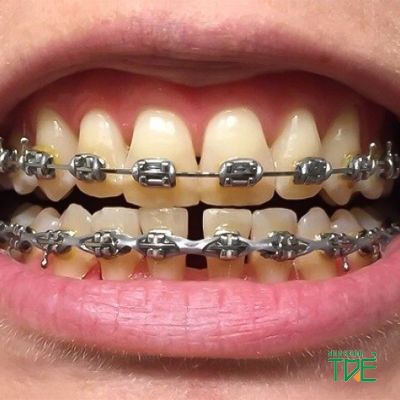 Răng bị ố vàng khi niềng răng có nên tẩy trắng không?