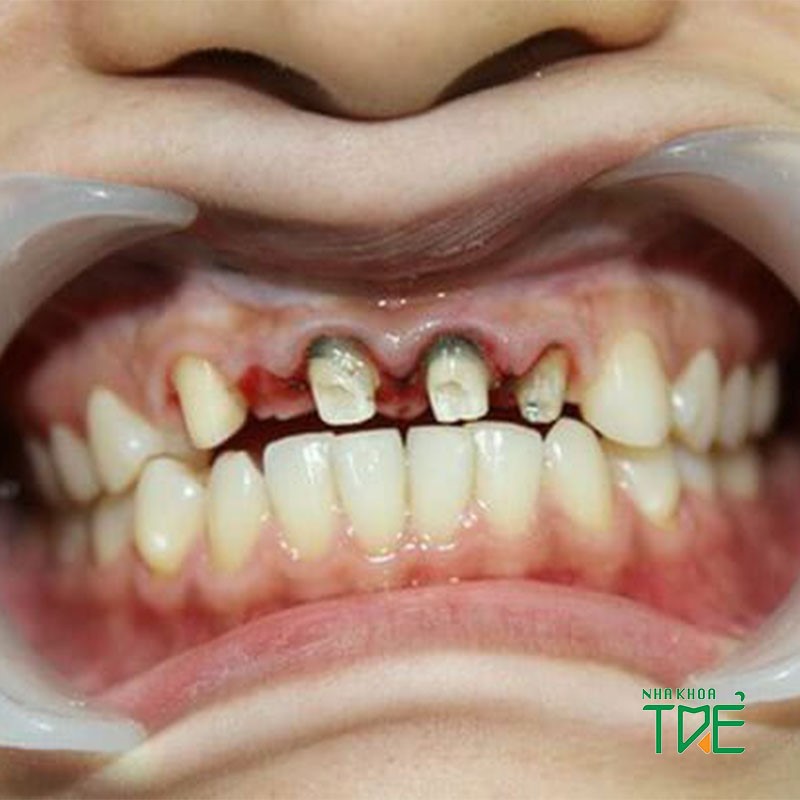 Răng bọc sứ bị viêm tủy: Nguyên nhân và cách điều trị