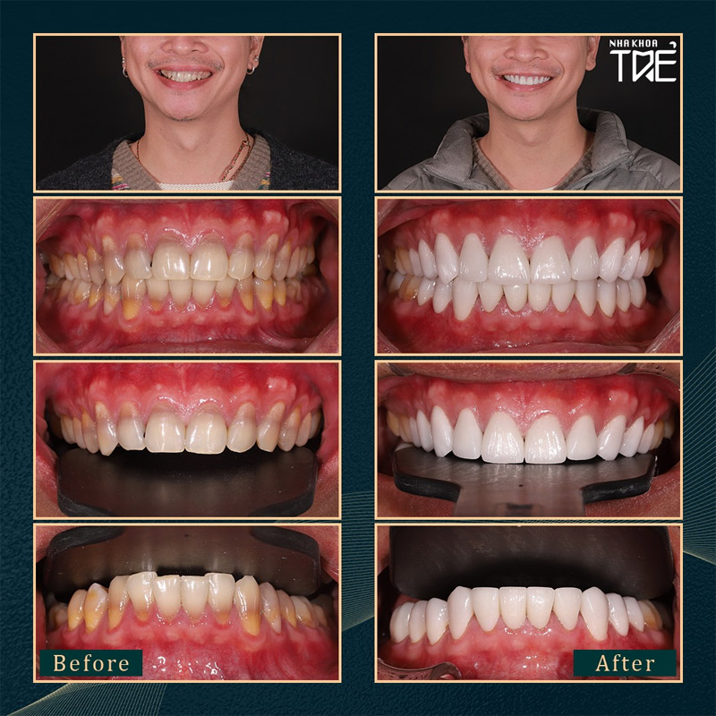 Phục hình răng sứ toàn hàm cải thiện răng xỉn màu