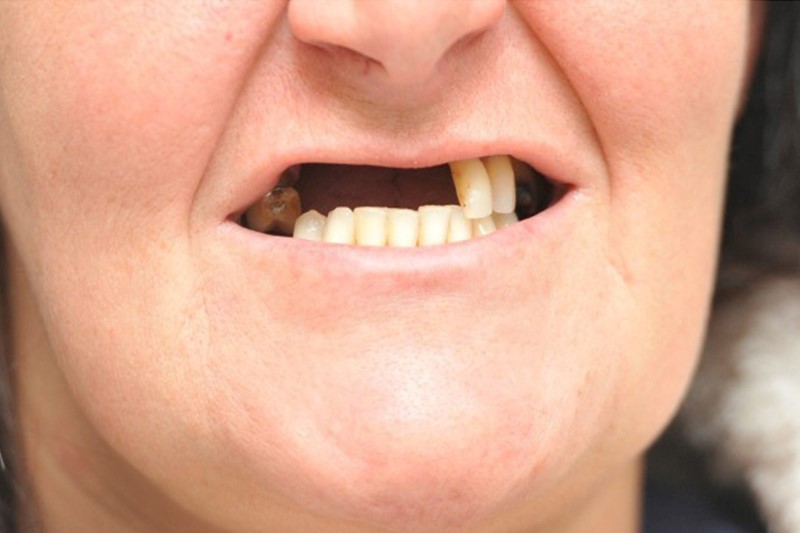 Mất răng hàm trên có thể dẫn đến tình trạng hô hàm dưới