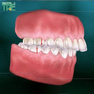 Răng hô hàm trên: Cách nhận biết và khắc phục triệt để