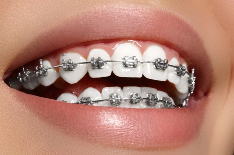 Khắc phục răng thừa bằng phương pháp niềng răng
