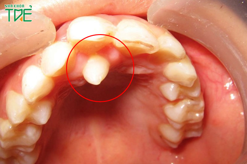 Răng mọc thừa ở trẻ em có nên nhổ không? Nhổ có nguy hiểm không?