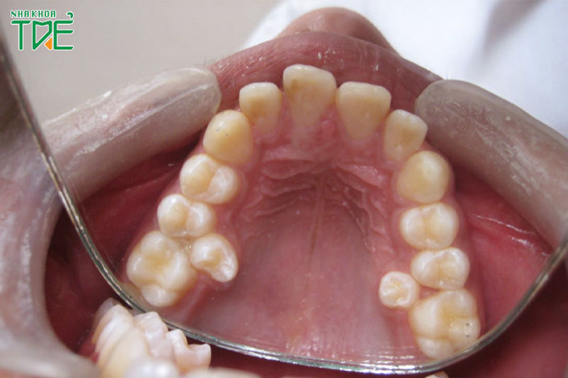 Răng mọc thừa vùng răng cối thứ 3