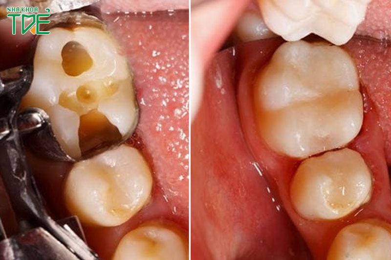 Trám răng tái tạo răng sâu hỏng