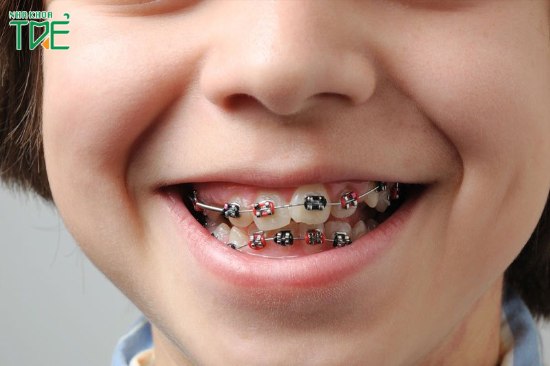 Niềng răng điều chỉnh khớp cắn lệch ở trẻ