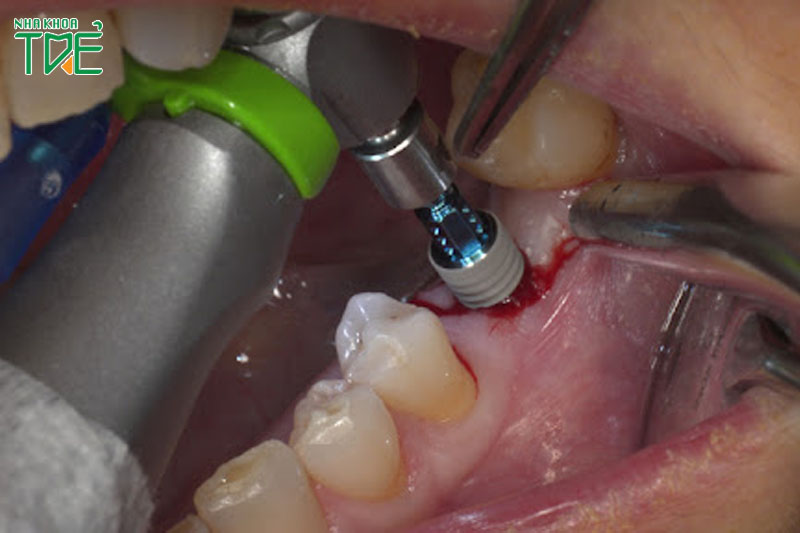 Cấy ghép Implant trực tiếp vào xương hàm