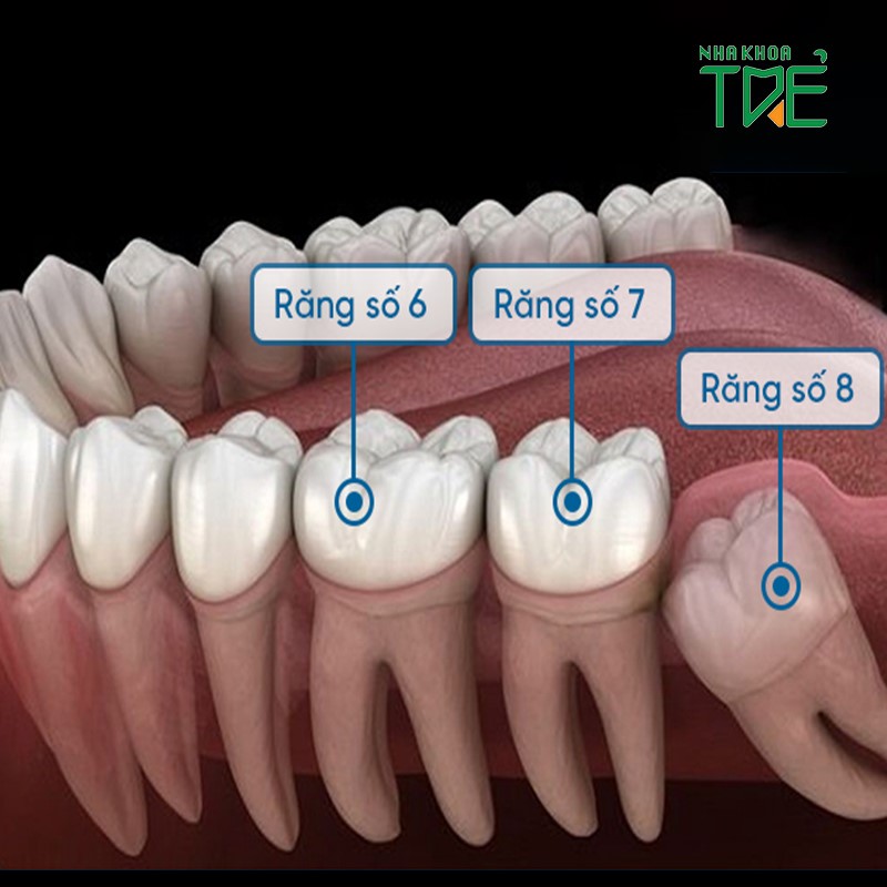 Trồng răng số 7 bằng phương pháp nào hiệu quả nhất?