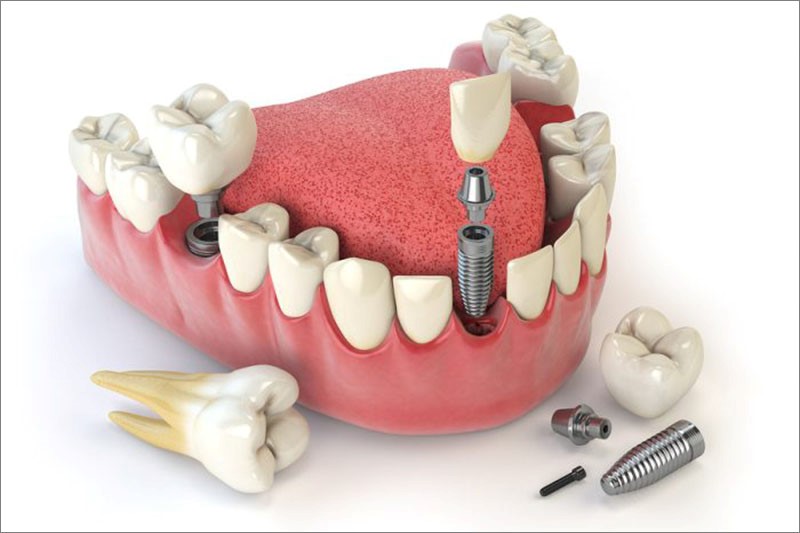 Cấy ghép răng Implant là một phương pháp trồng răng hàm số 7 tối ưu nhất