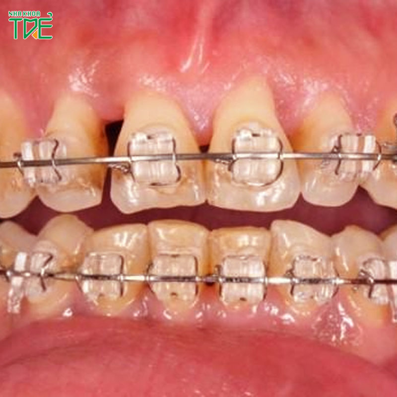 Bị tụt lợi có niềng răng được không? Có gây hại gì không?