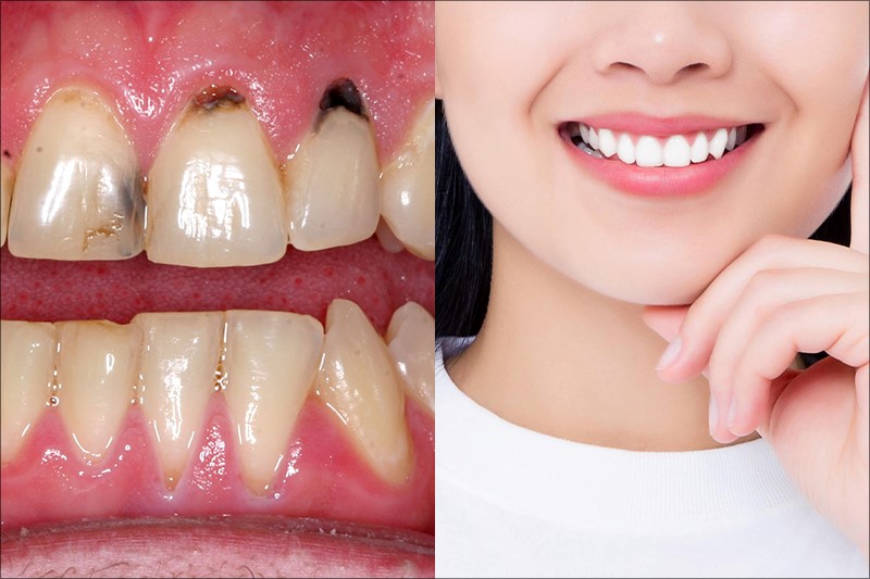 Bọc lại sứ để khắc phục tình trạng bọc răng sứ bị nhiễm trùng