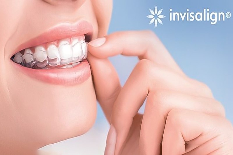 Niềng răng không gắn khâu áp dụng với niềng răng trong suốt Invisalign