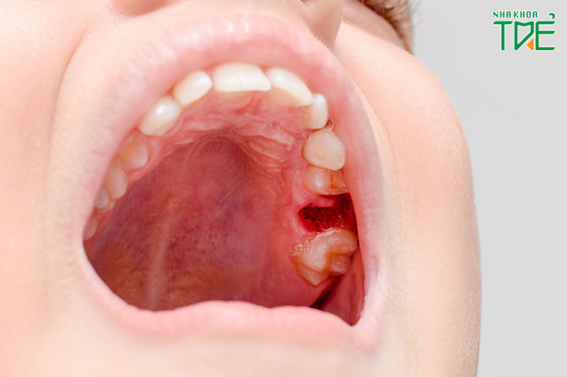 Há miệng hạn chế sau nhổ răng dưới 35mm