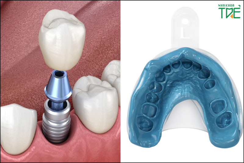 Lấy dấu Implant là gì? Quy trình lấy dấu phục hình răng Implant