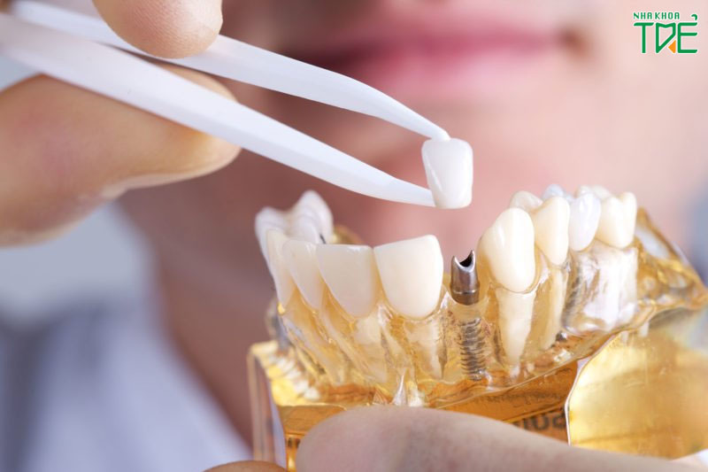 Lấy dấu răng ảnh hưởng trực tiếp đến kết quả trồng răng