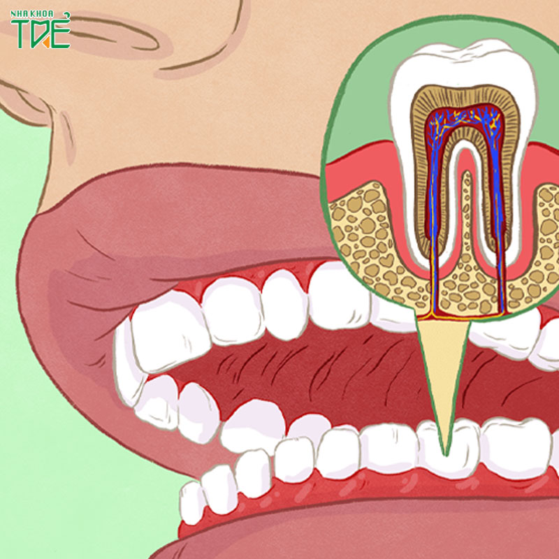 Lấy tủy răng xong vẫn bị đau: Nguyên nhân và cách khắc phục tối ưu