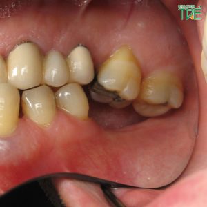 Mất 2 răng hàm gây hậu quả gì? Trồng răng hàm loại nào tốt nhất?
