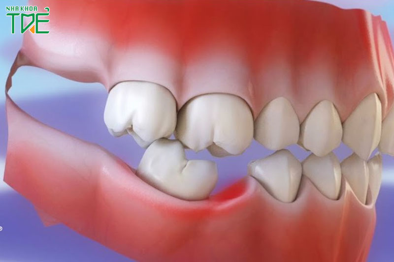Mất răng gây ra nhiều vấn đê răng miệng