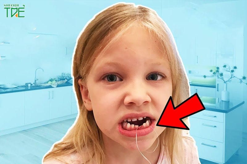 Nhổ răng bằng chỉ tại nhà gây nguy hiểm cho trẻ