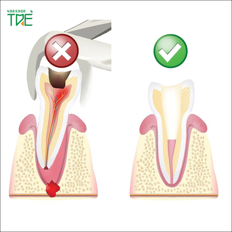 Khi nào cần nhổ răng đã lấy tủy không? Nhổ răng có đau không?