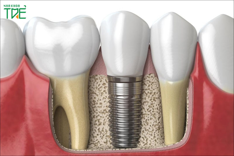 Nên trồng răng sau mất răng để ngăn ngừa biến chứng