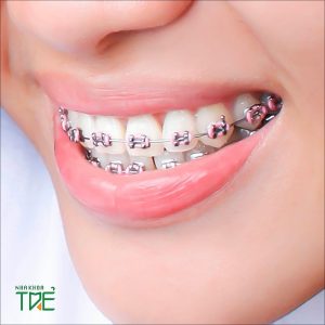 Niềng răng ở Hàn Quốc giá bao nhiêu? Có tốt hay không?