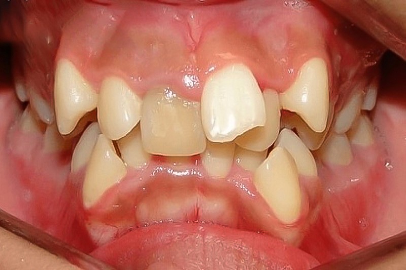Răng lồi xỉ khiến các răng trong hàm chen chúc, mọc không đúng vị trí