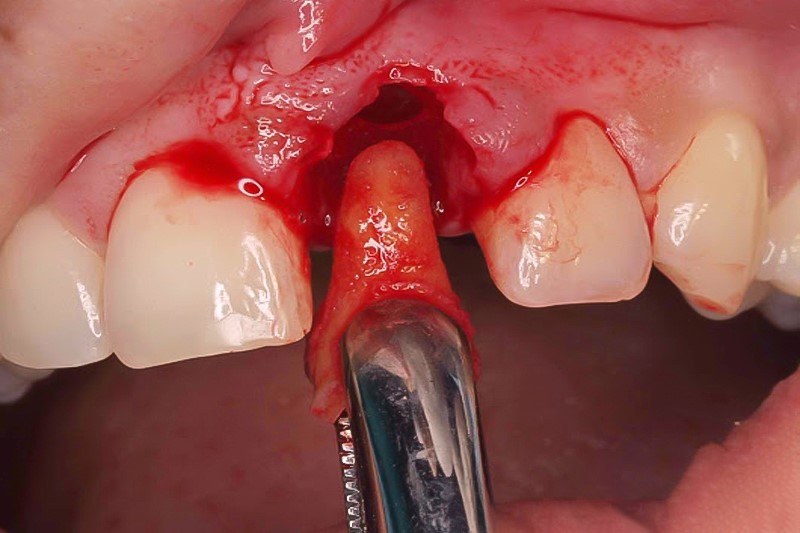 Nhổ răng là một trong những phương pháp khắc phục răng lồi xỉ