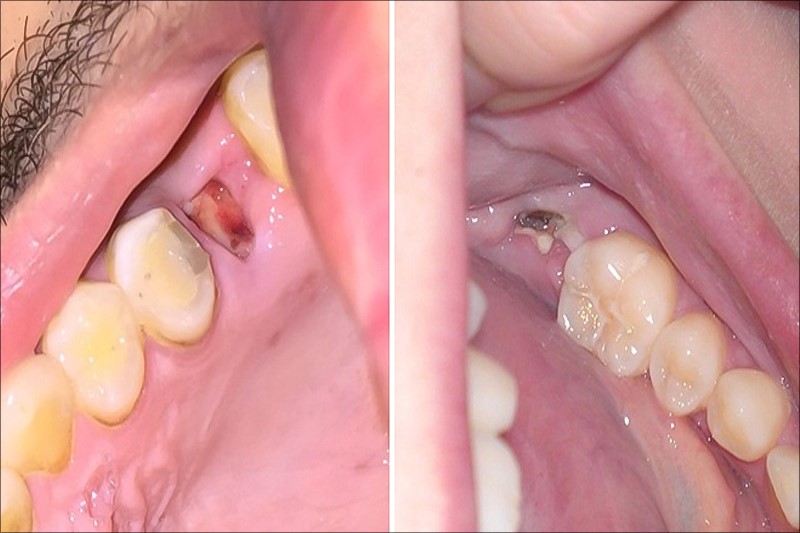 Sót chân răng có thể gây ra tình trạng sốt sau nhổ răng khôn
