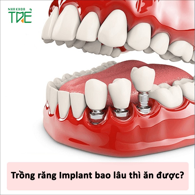 Trồng răng Implant bao lâu thì ăn được?