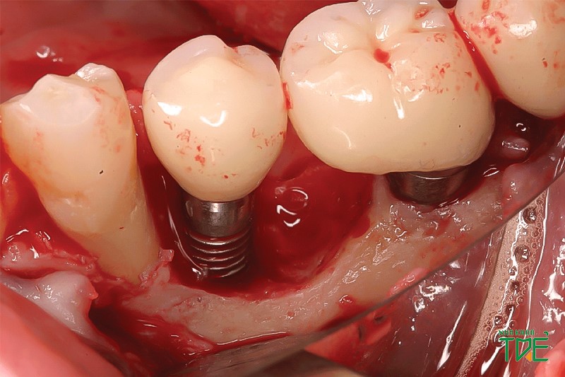 Không nhai trực tiếp răng mới cấy ghép vì có thể xảy ra tình trạng chảy máu kéo dài
